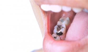 عوارض و مراقبت‌های بعد از پر کردن دندان‌ها چیست؟